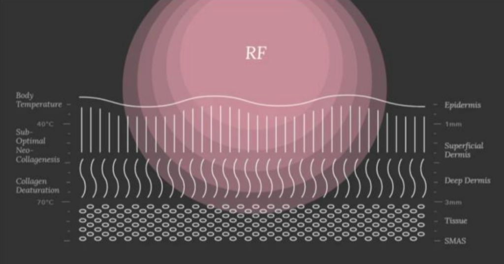 RF射頻熱能筋膜刀原理